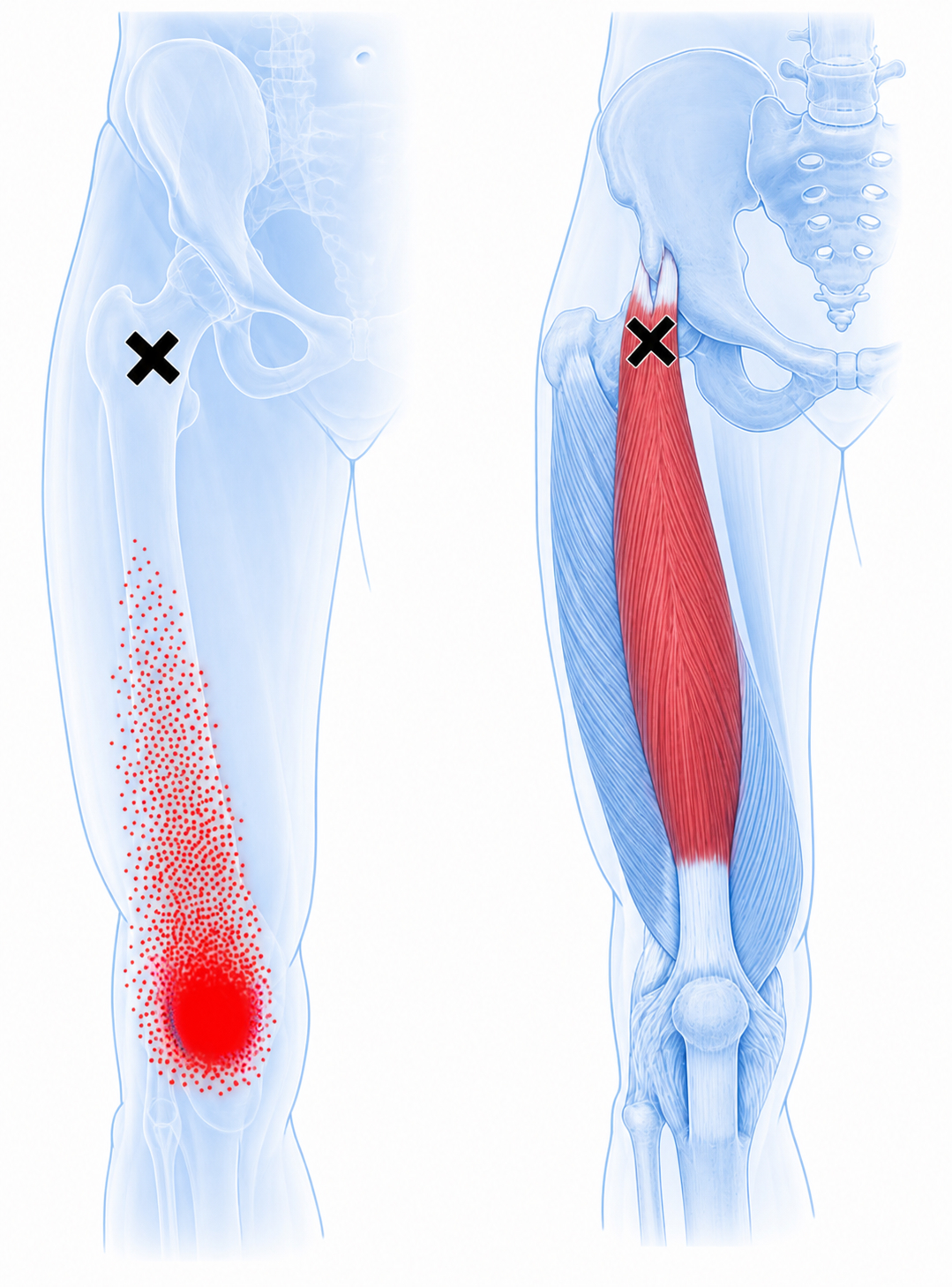 Rectus femoris