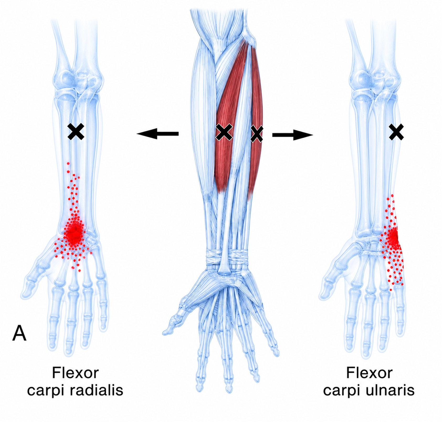 Flexor carpi radialis