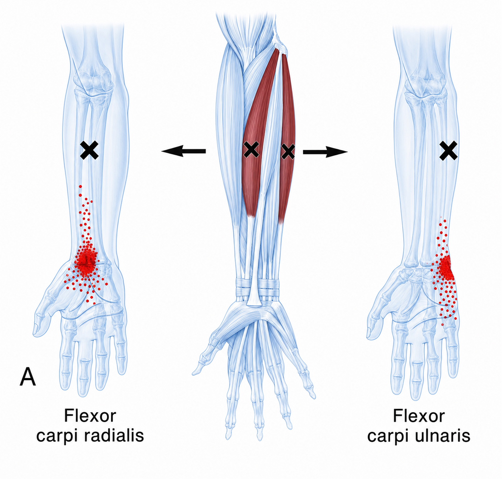 Flexor carpi radialis