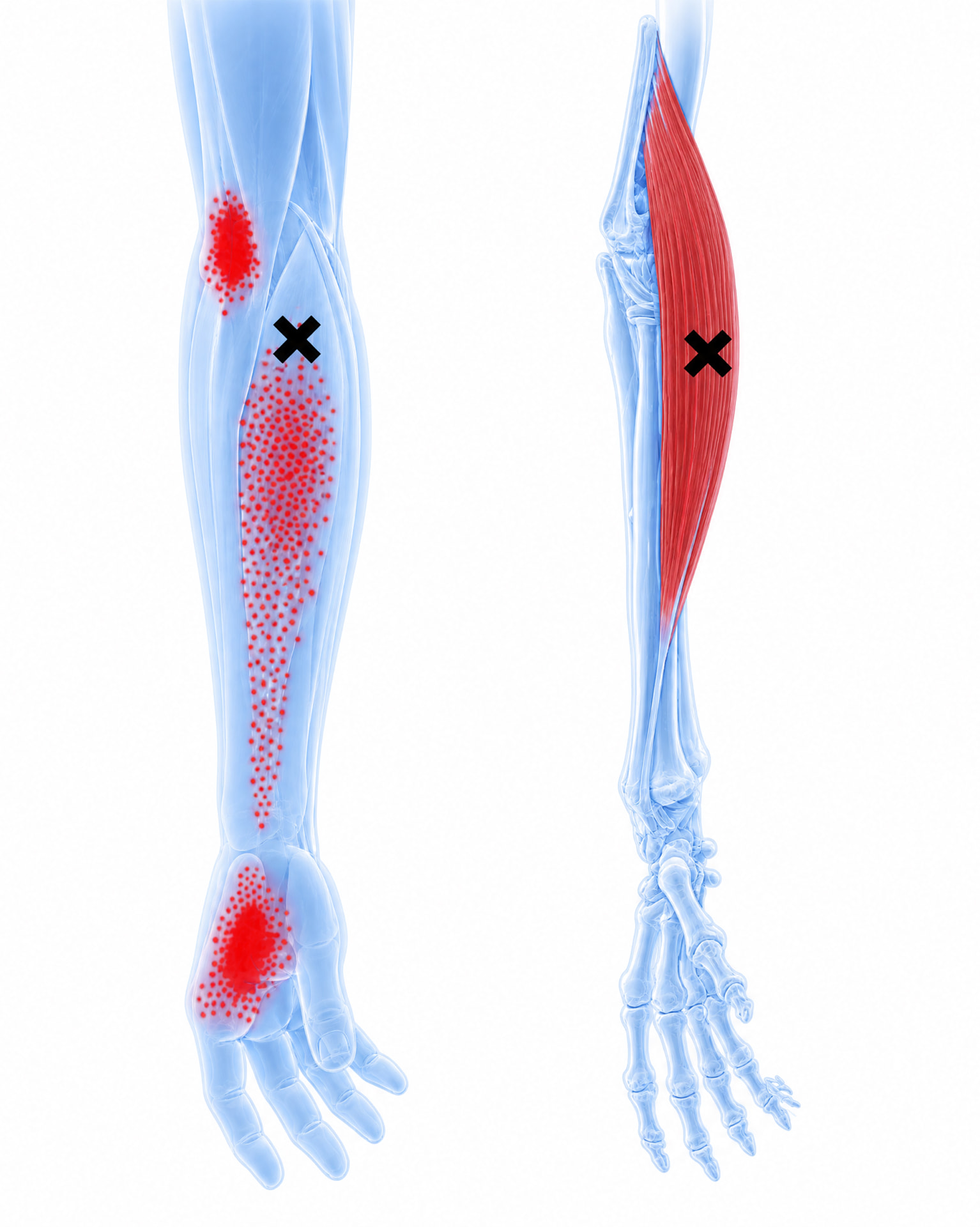 Brachioradialis