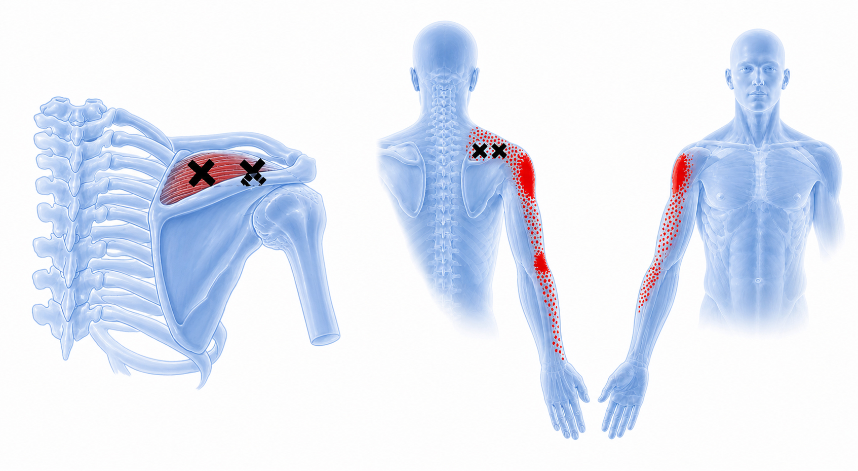 Supraspinatus
