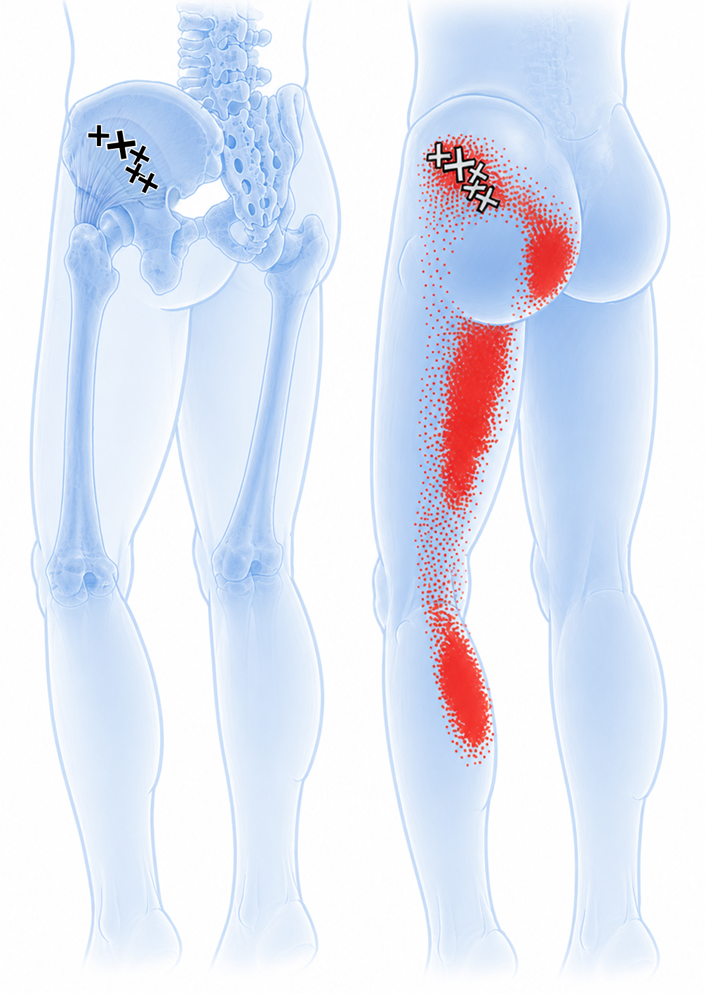 Gluteo piccolo