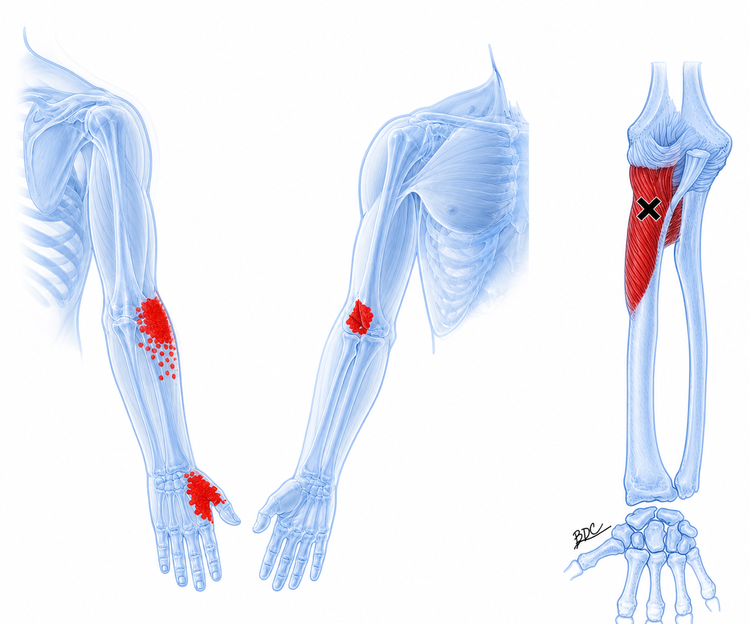 Supinator