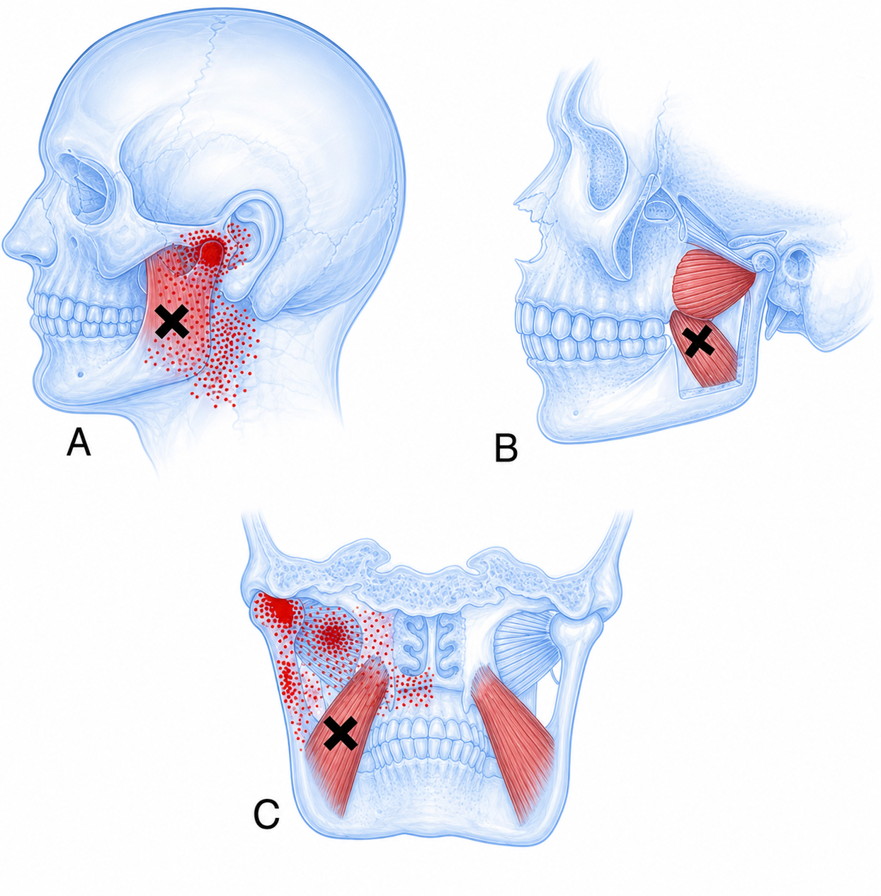 Medial pterygoid