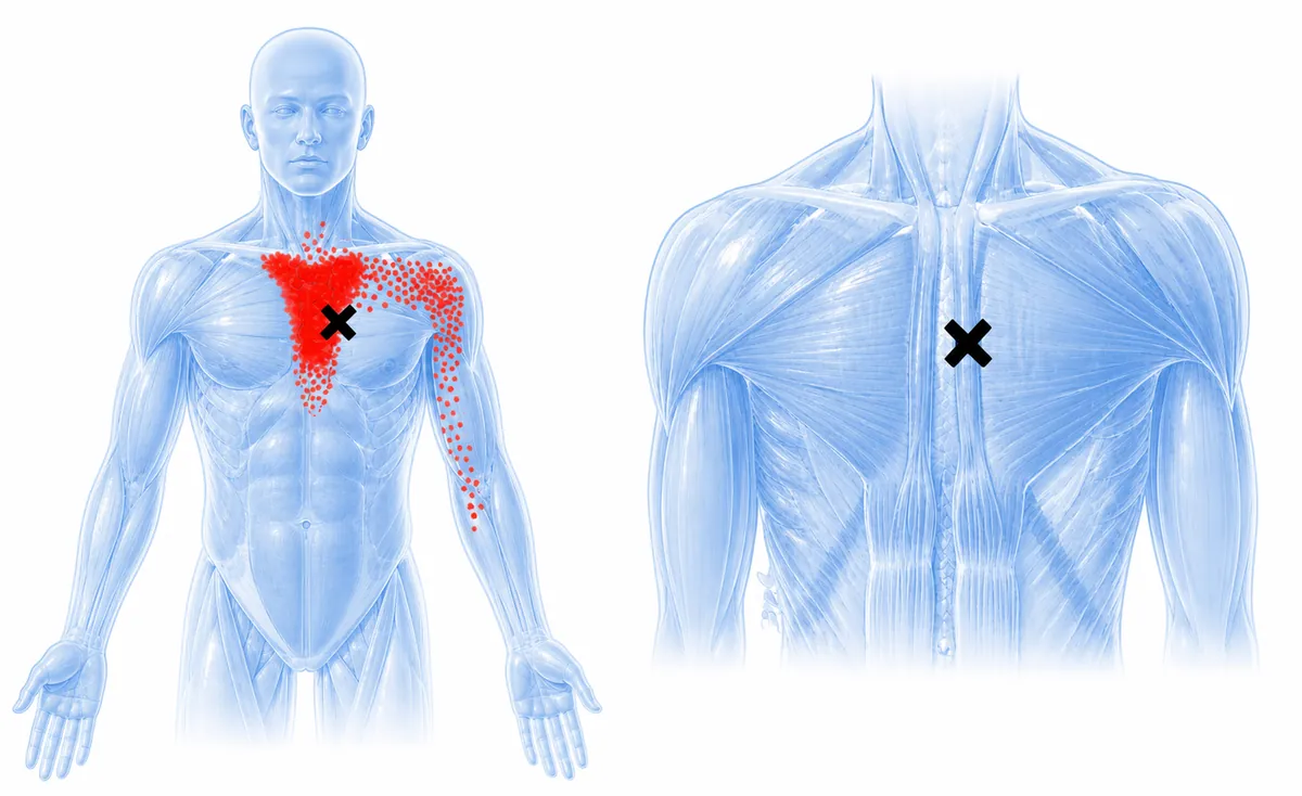 Sternalis — trigger points and referred pain pattern. — Reference diagram 1