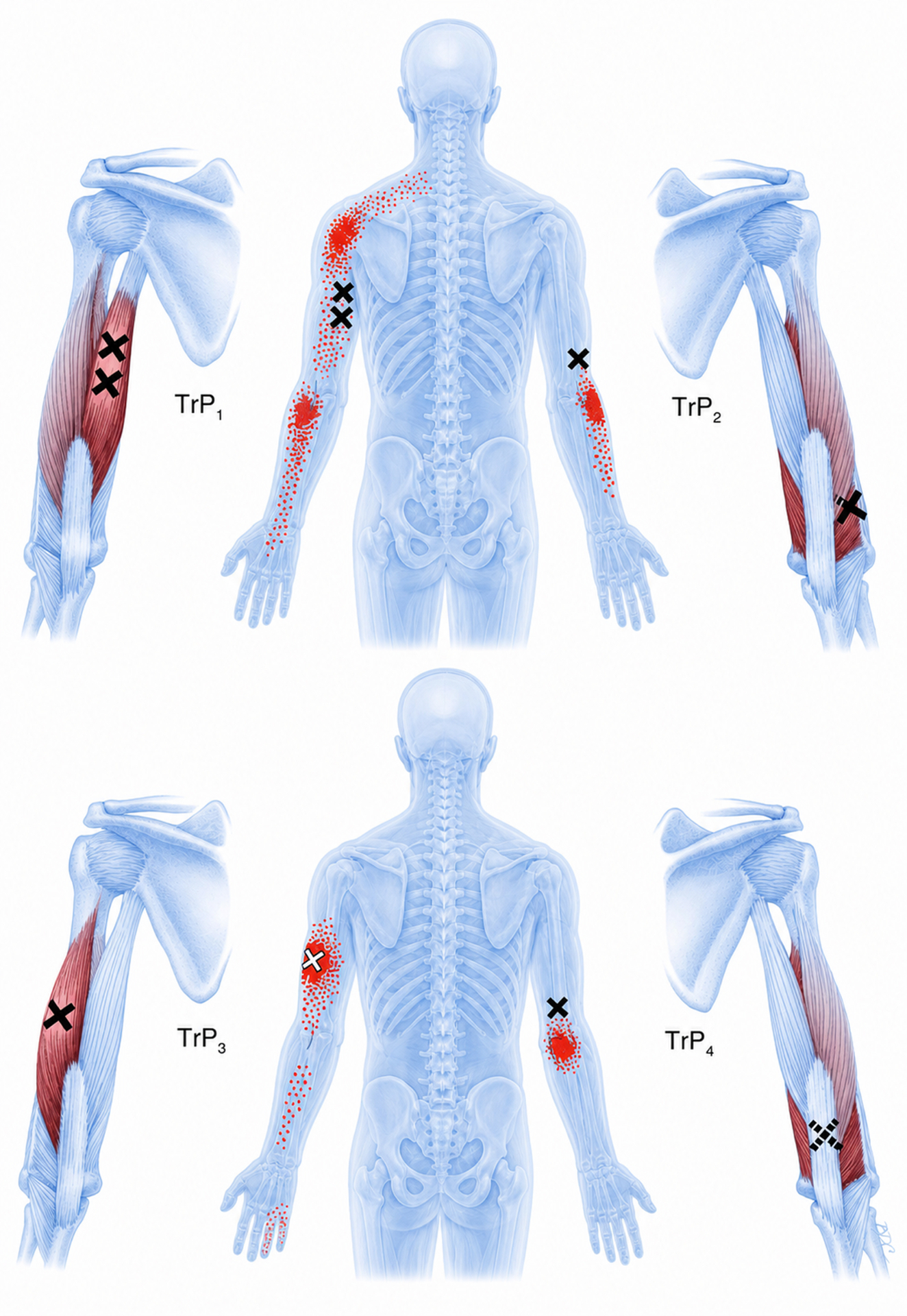 Triceps brachii