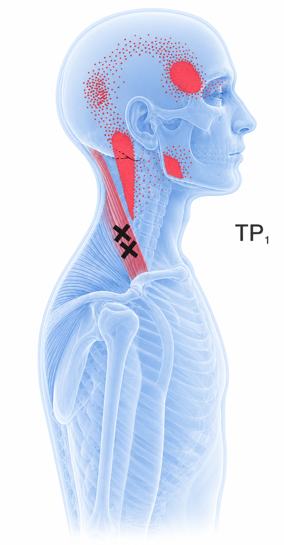 Upper trapezius