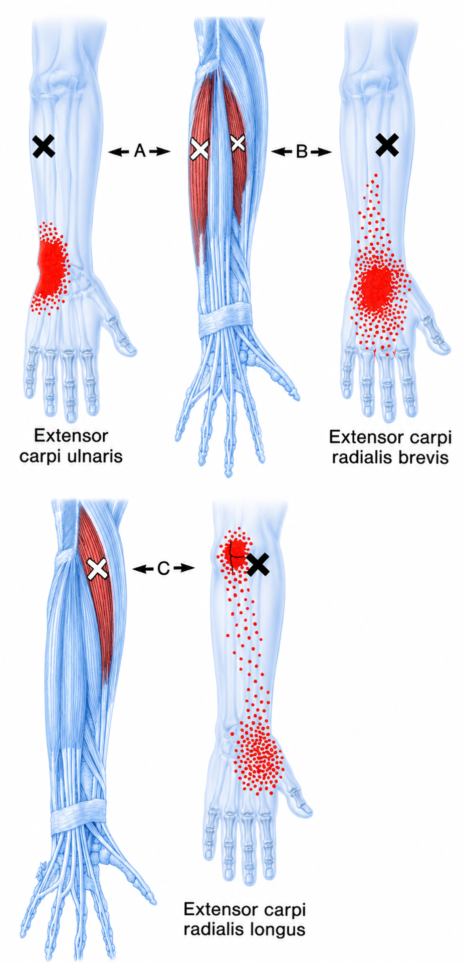 Extensor carpi radialis