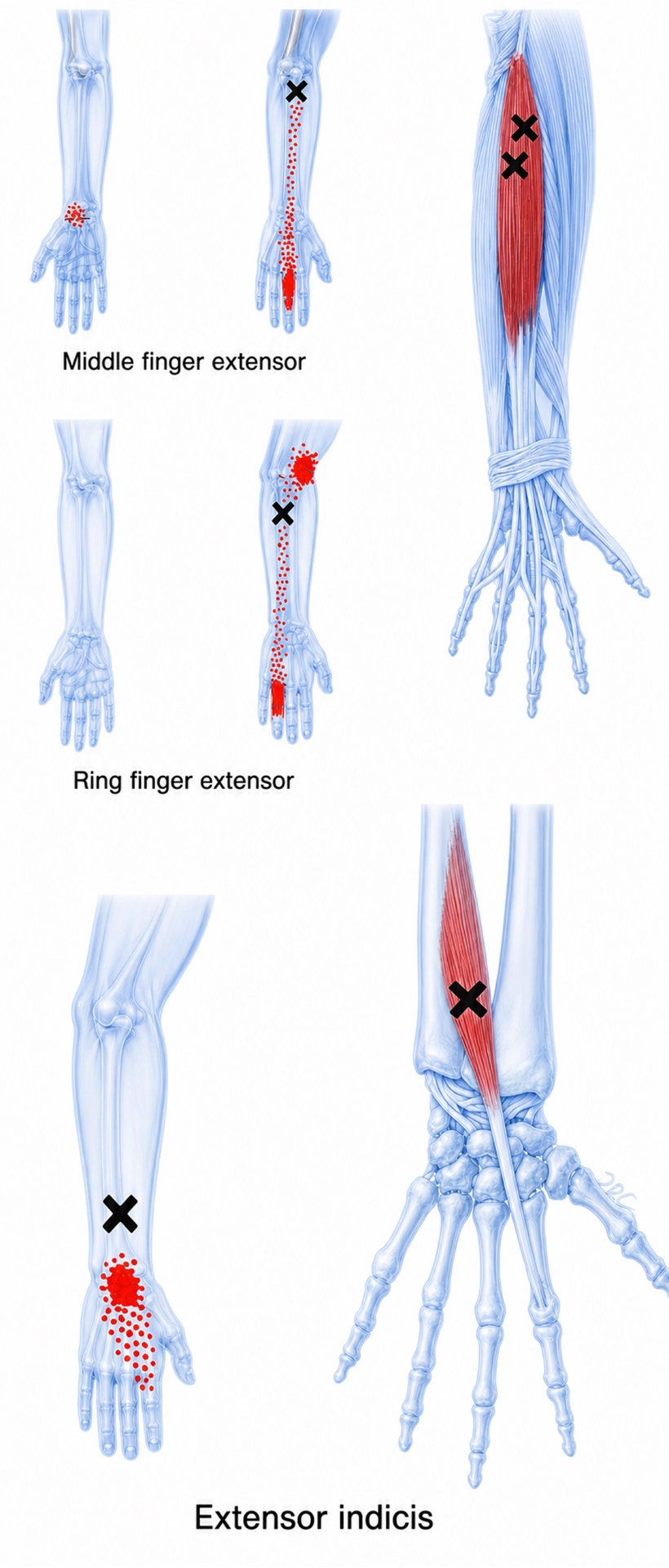 Extensor digitorum