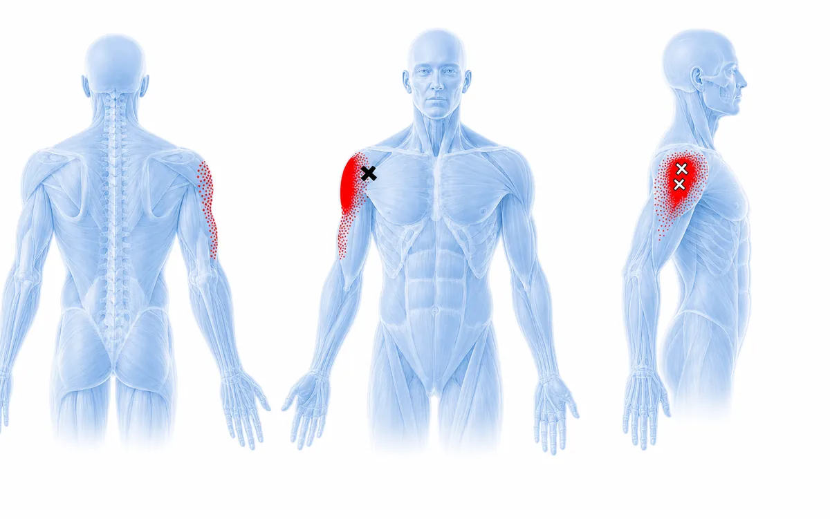 Deltoid — trigger points and referred pain pattern. — Reference diagram 1