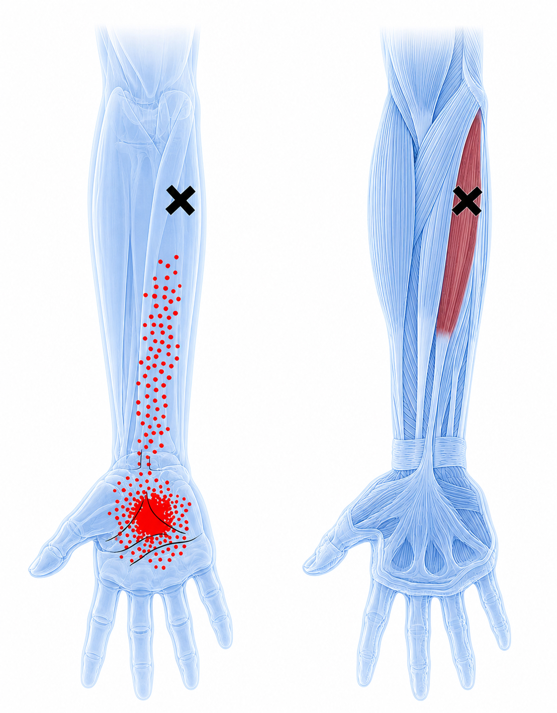 Palmar largo