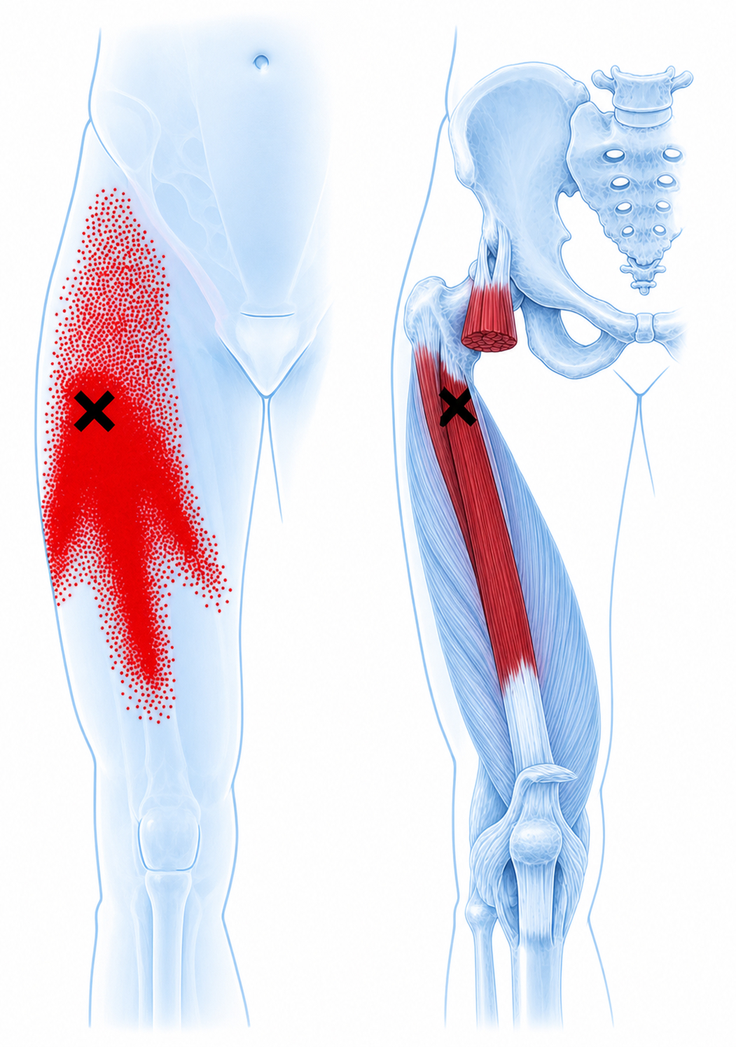 Vastus intermedius