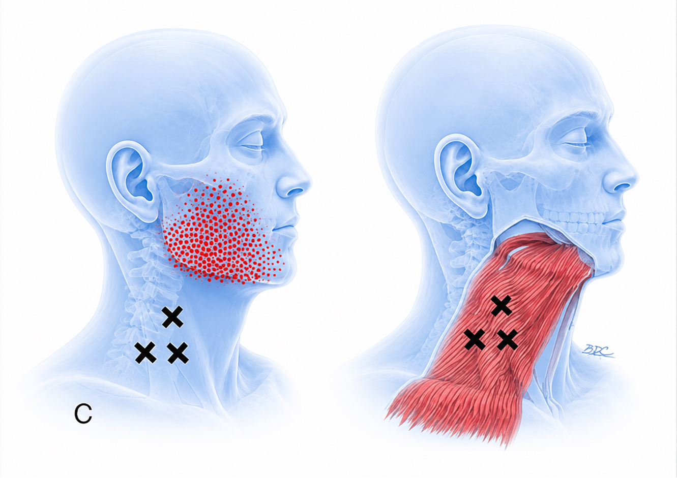 Platysma