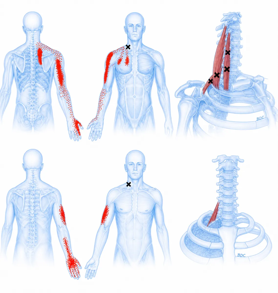 Scalenes — anterior/middle/posterior scalene trigger points along the lateral neck refer a wide, dramatic pattern: down the front of the chest, along the medial scapular border and upper back, over the deltoid, down the arm and forearm to the thumb and index finger; a classic mimic of C6/C7 cervical radiculopathy and thoracic outlet syndrome. — Reference diagram 1