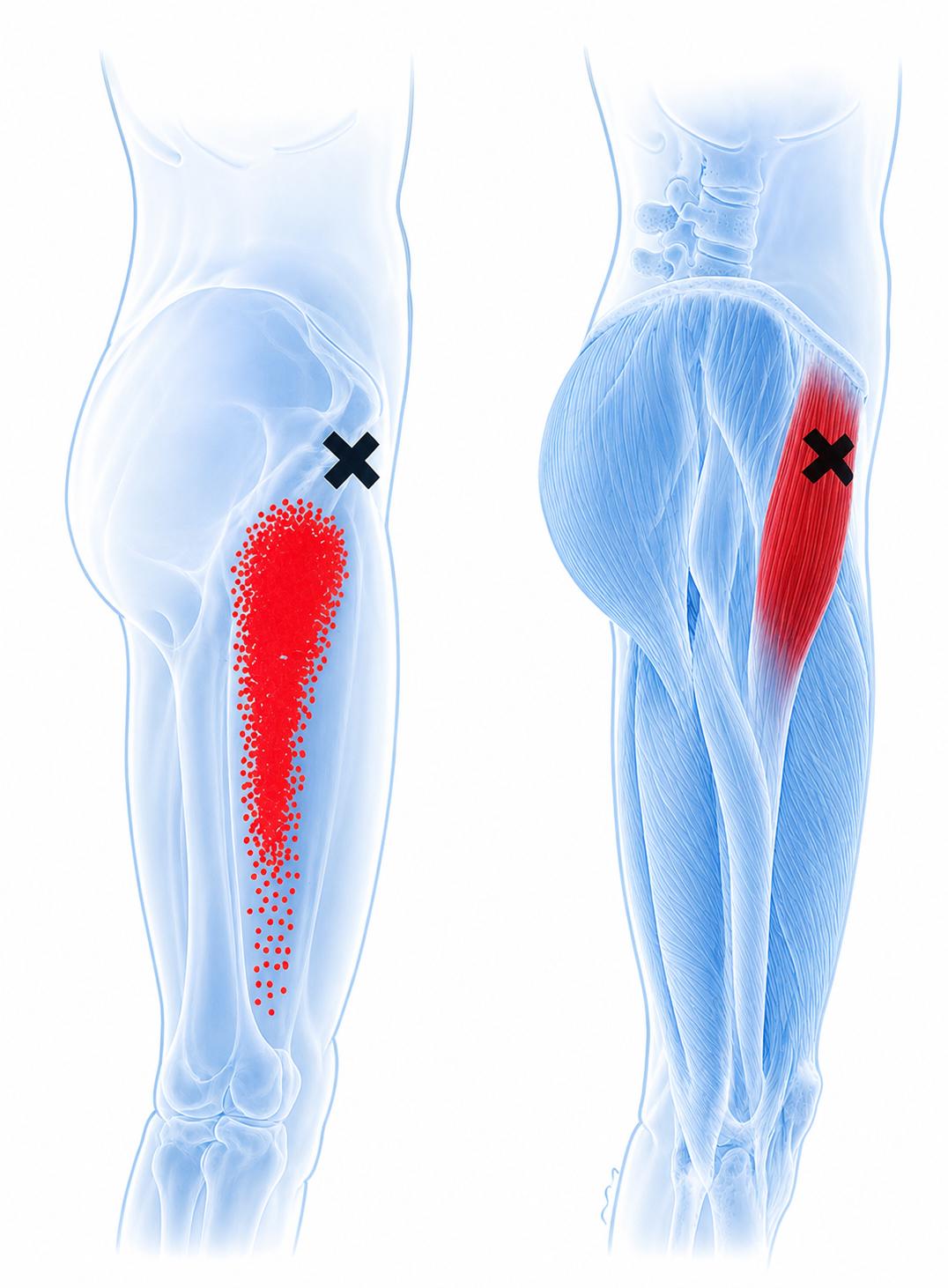Tensor fasciae latae