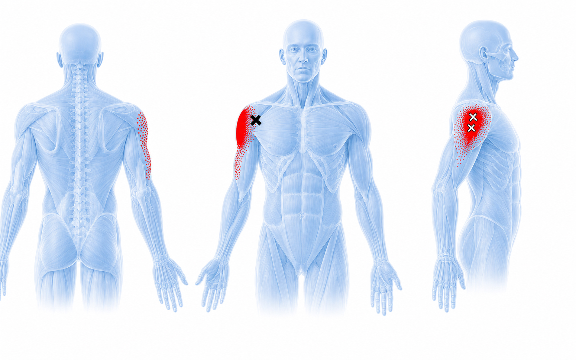 Deltoid