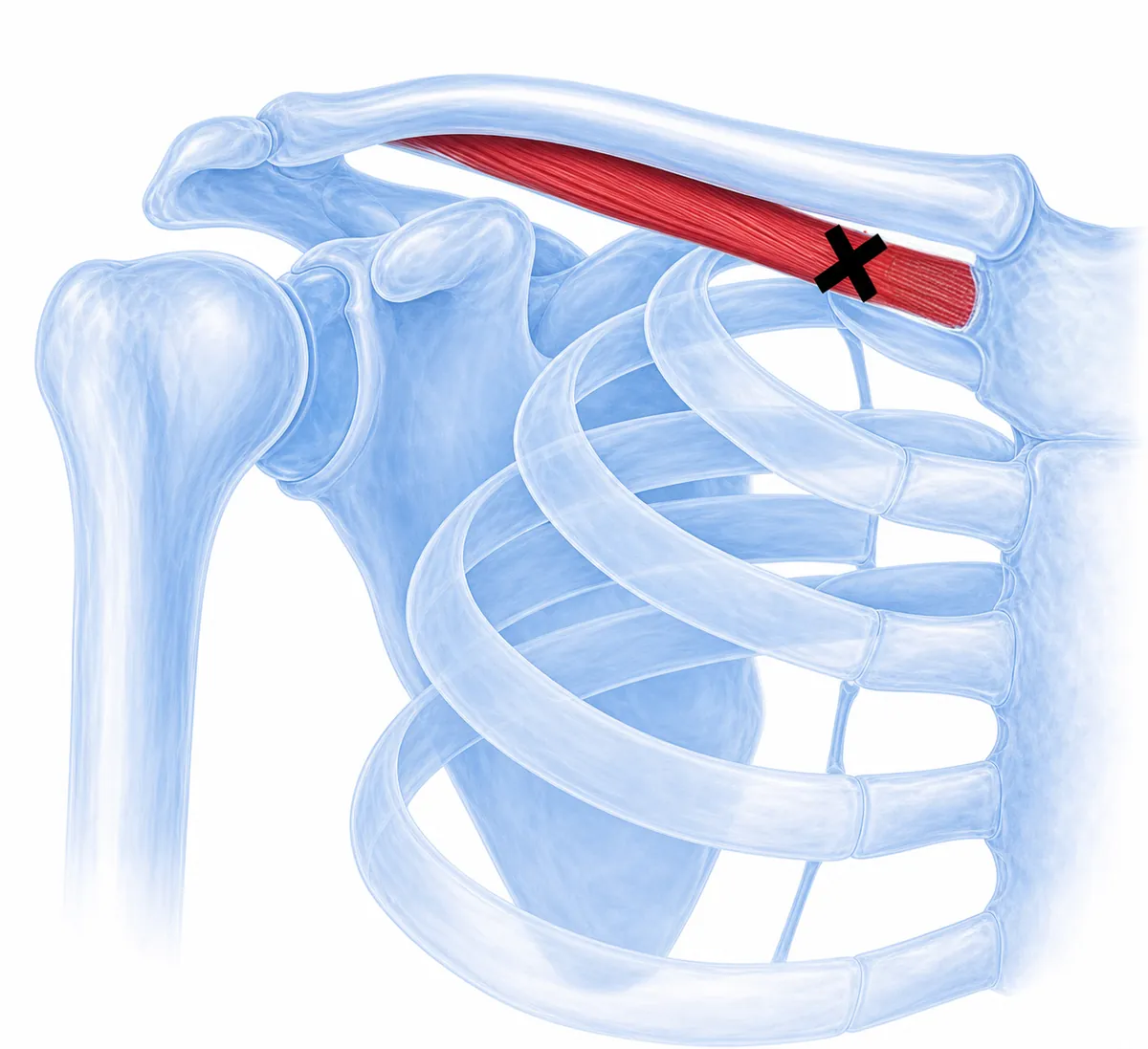 Subclavius — close-up of the small muscle running under the clavicle from first rib to clavicle, showing the classic trigger point location tucked beneath the medial clavicle. — Reference diagram 1