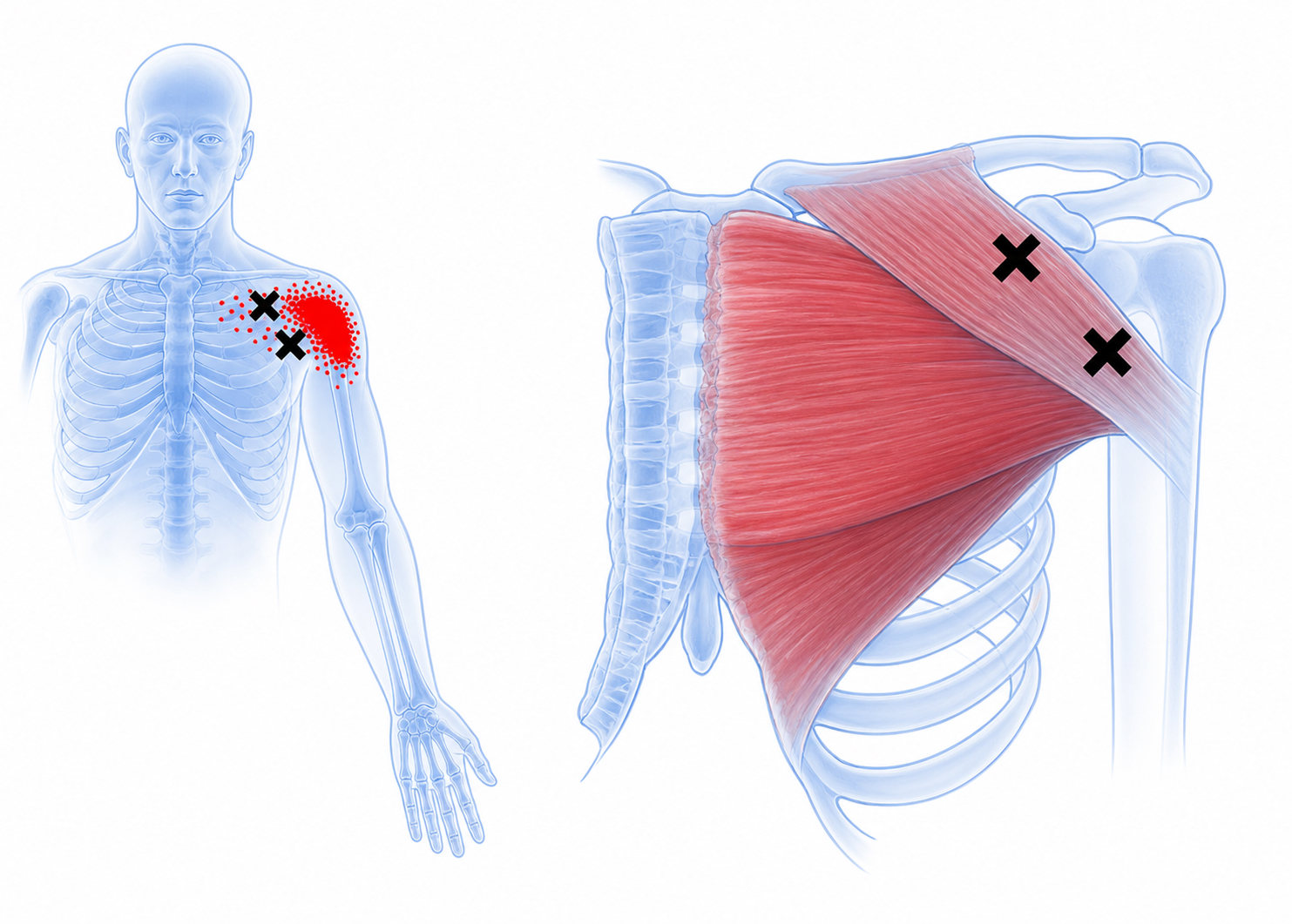 Pectoralis major