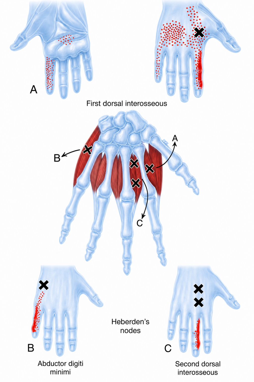 Abductor Digiti Minimi (Hand)