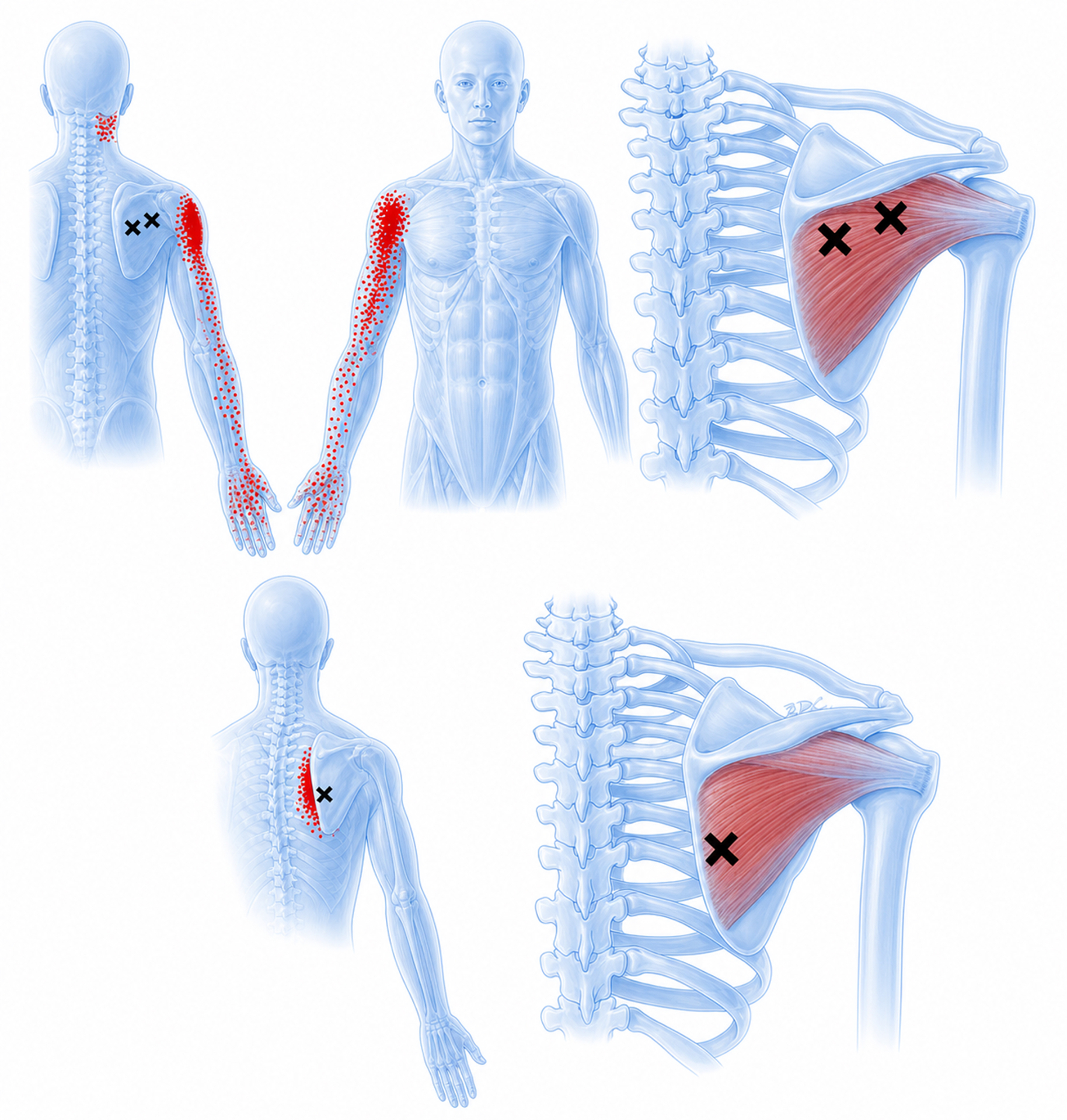 Infraspinatus