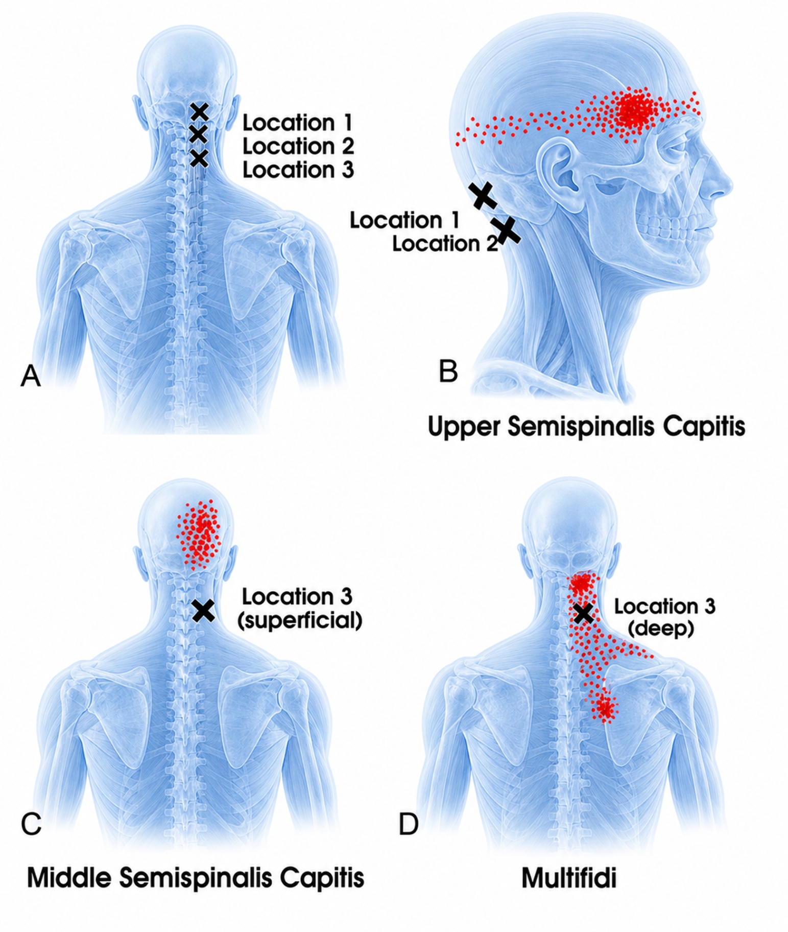Semispinalis capitis