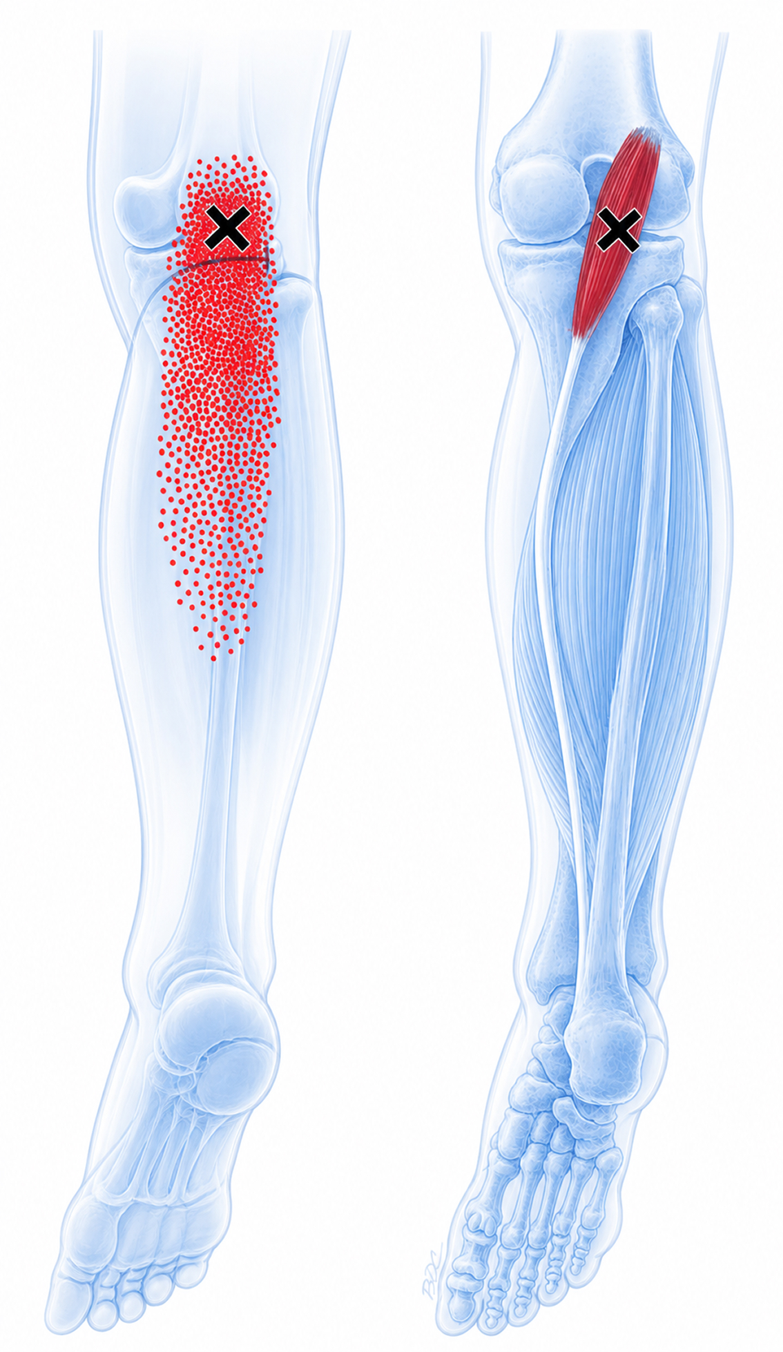 Plantar