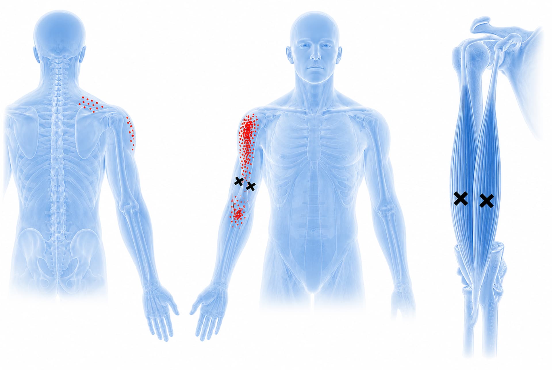 Biceps Brachii