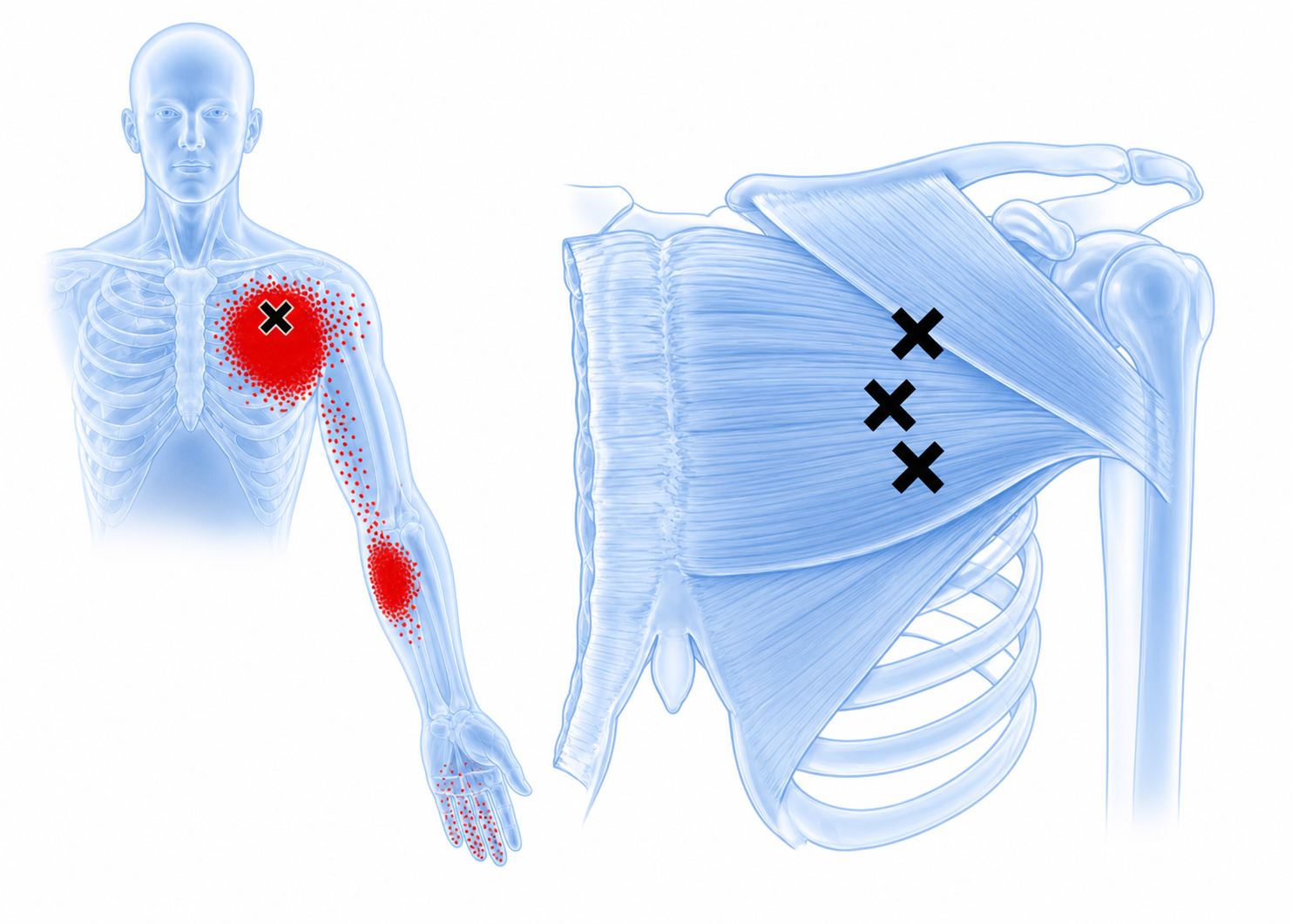 Pectoralis major