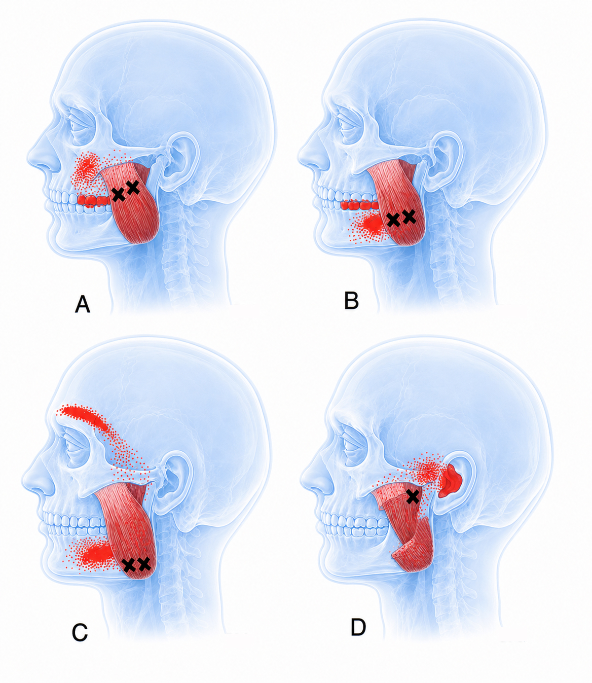 Masseter