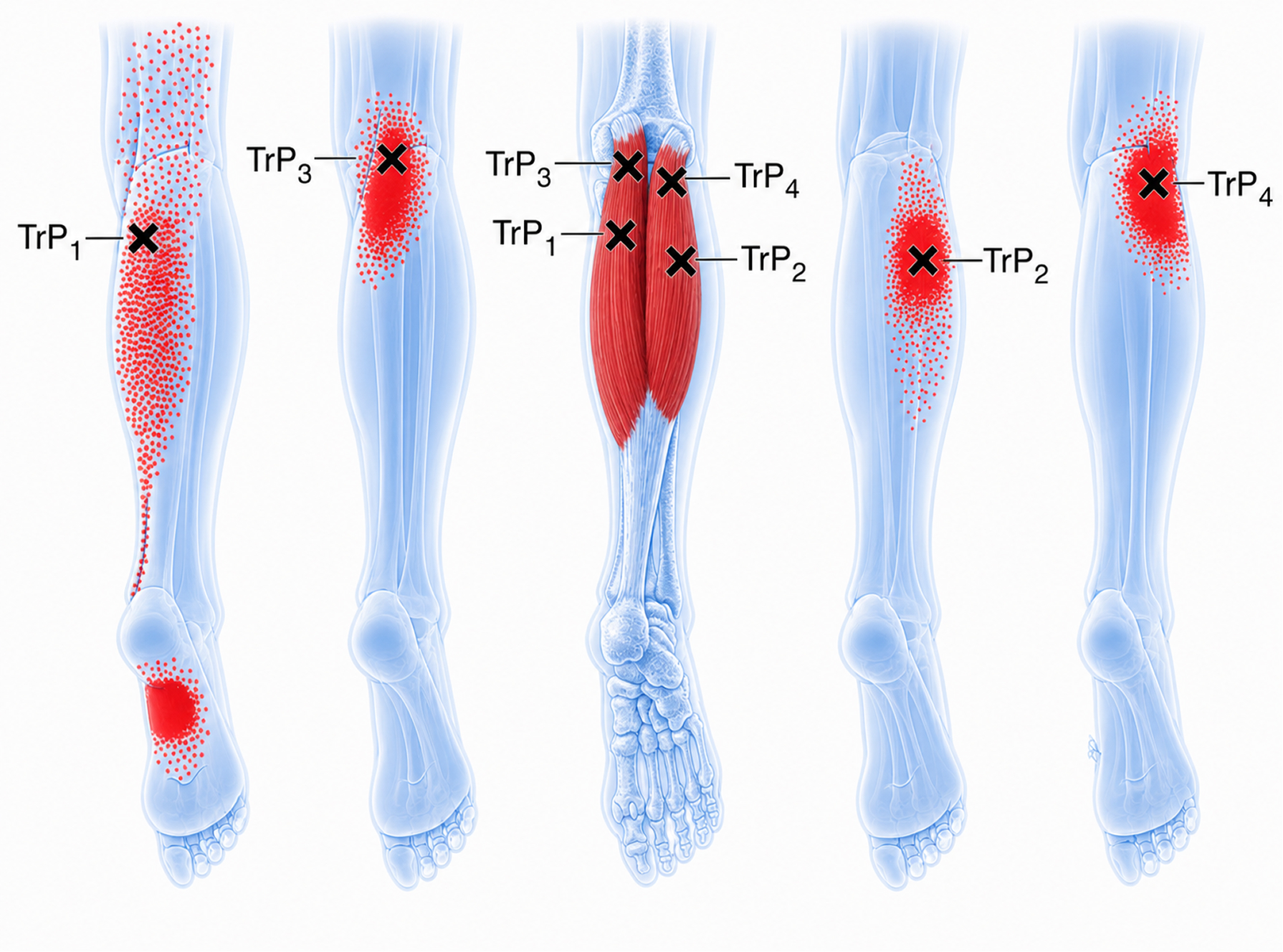 Gastrocnemius